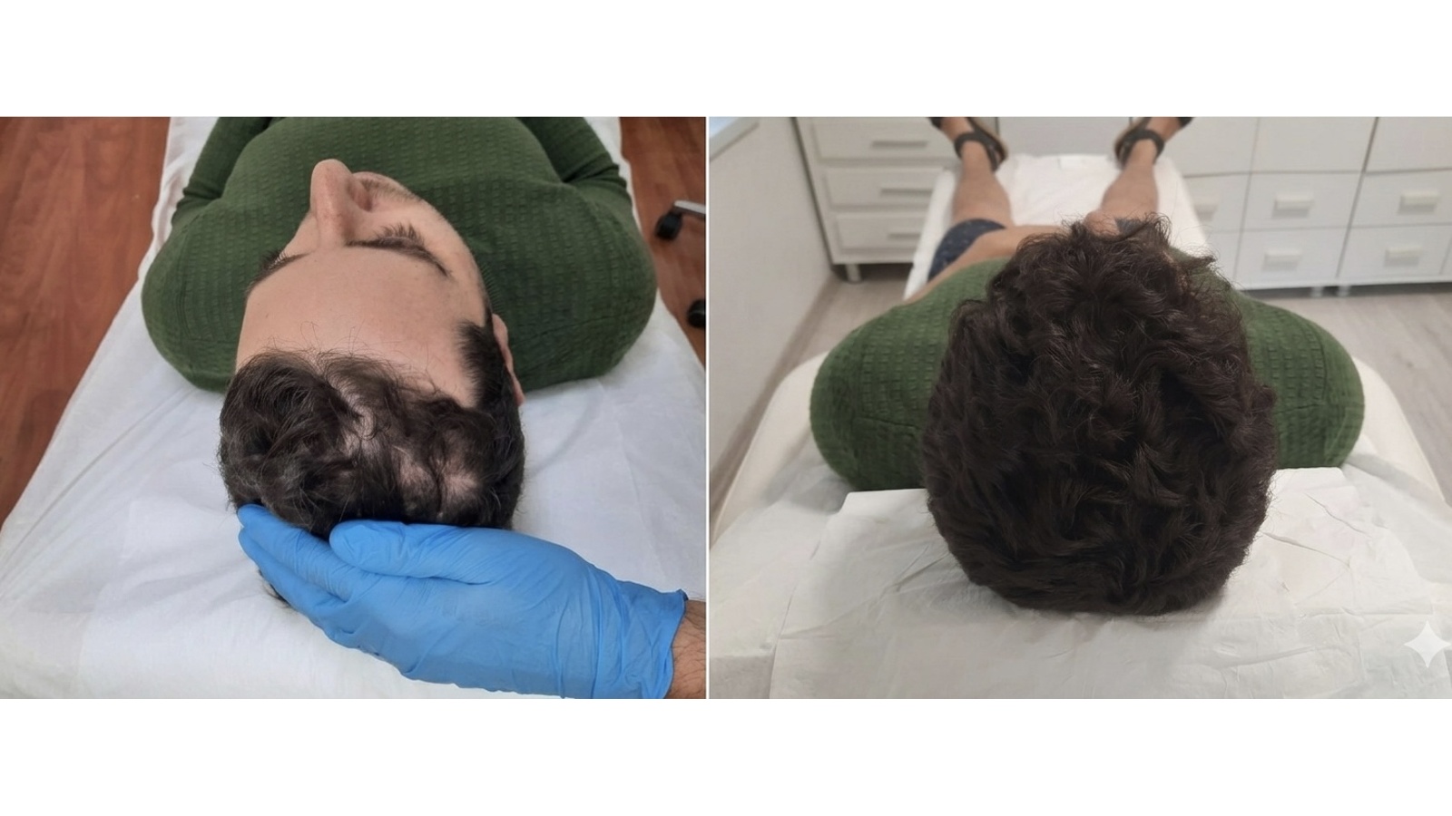לפני ואחרי — התקרחות בקודקוד — גבר